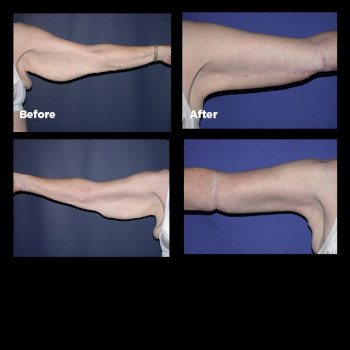 Arm-Lift-(Brachioplasty)06