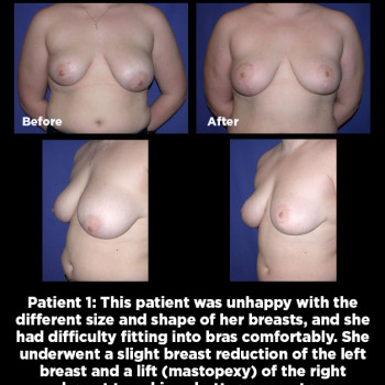 Breast-Asymmetry-Correction01