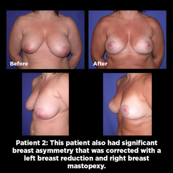 Breast-Asymmetry-Correction02