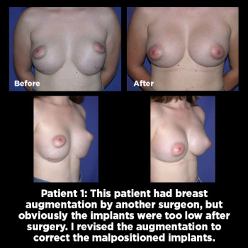 Breast-Augmentation-Revision01