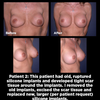 Breast-Augmentation-Revision02