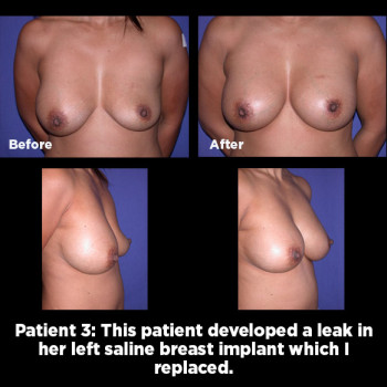 Breast-Augmentation-Revision03