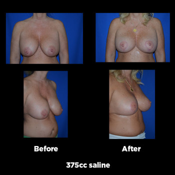 Breast-Augmentation-Revision04