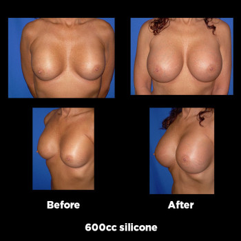 Breast-Augmentation-Revision05