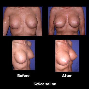 Breast-Augmentation-Revision11