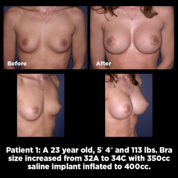 Breast-Augmentation01