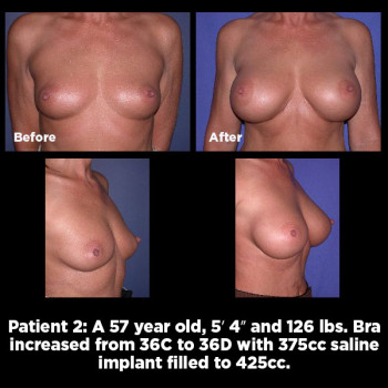 Breast-Augmentation02