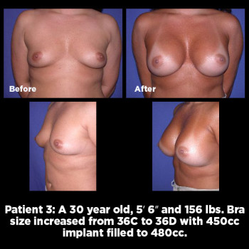 Breast-Augmentation03