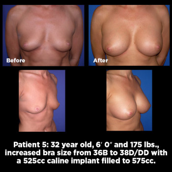 Breast-Augmentation05
