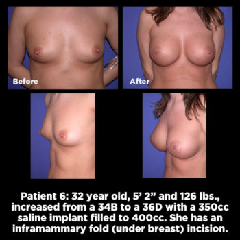 breast-augmentation06