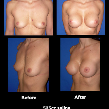 Breast-Augmentation08