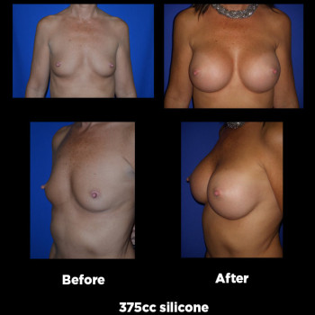 Breast-Augmentation10