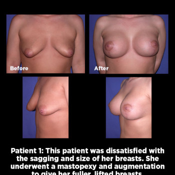 Breast-Lift-(Mastopexy)01