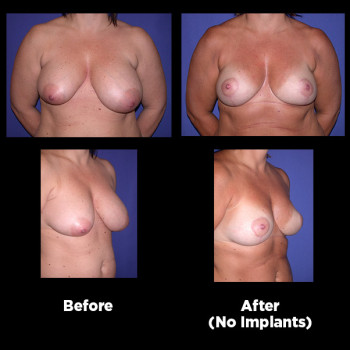 Breast-Lift-(Mastopexy)11