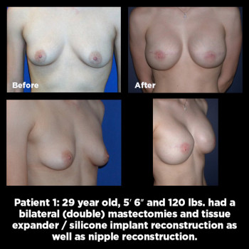 Breast-Reconstruction01