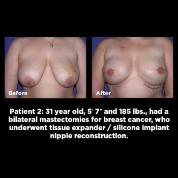 Breast-Reconstruction02