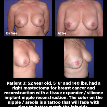 Breast-Reconstruction03
