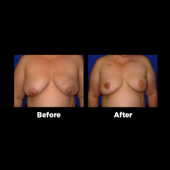 Breast-Reconstruction04
