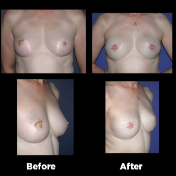 Breast-Reconstruction06