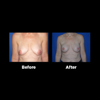 Breast-Reconstruction08