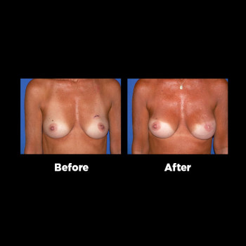 Breast-Reconstruction10