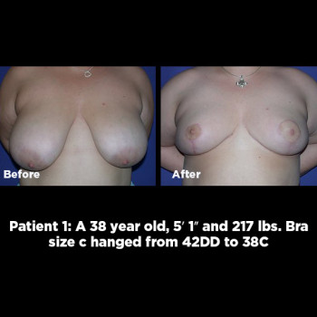 Breast-Reduction01