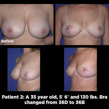 Breast-Reduction02