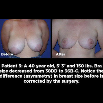 Breast-Reduction03
