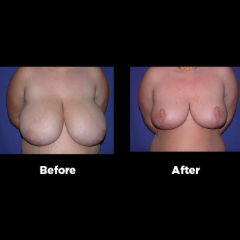 Breast-Reduction05