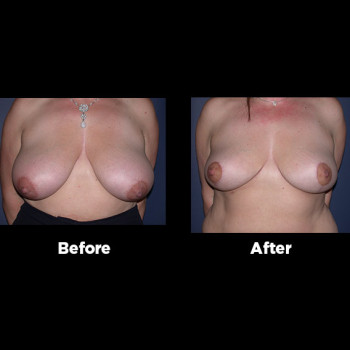 Breast-Reduction06
