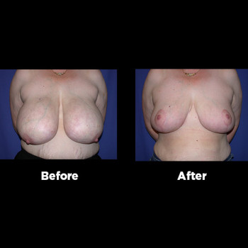 Breast-Reduction07