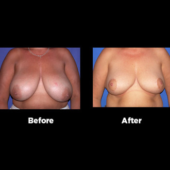 Breast-Reduction08