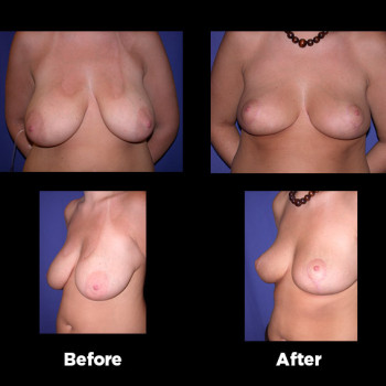 Breast-Reduction09