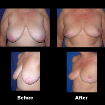 Breast-Reduction10