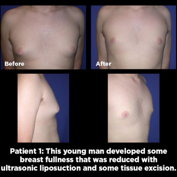 Male-Breast-Reduction01