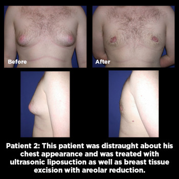 Male-Breast-Reduction02