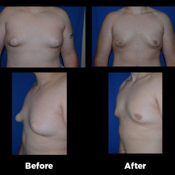 Male-Breast-Reduction04