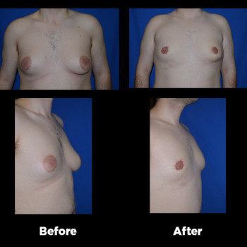 Male-Breast-Reduction06