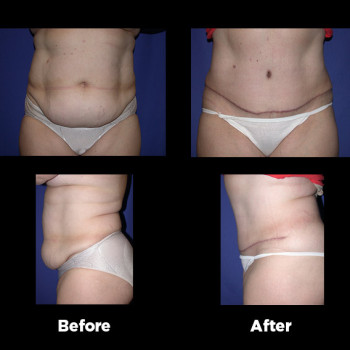 Tummy-Tuck-(Abdominoplasty)08