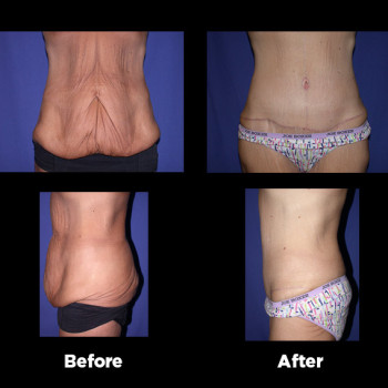 Tummy-Tuck-(Abdominoplasty)16