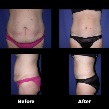 Tummy-Tuck-(Abdominoplasty)21