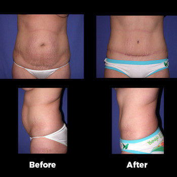 Tummy-Tuck-(Abdominoplasty)23