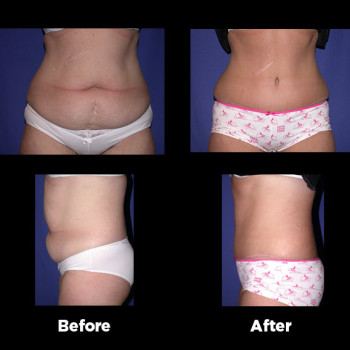 Tummy-Tuck-(Abdominoplasty)28