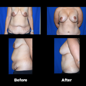 Tummy-Tuck-(Abdominoplasty)39