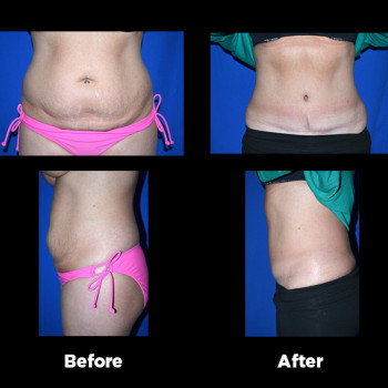 Tummy-Tuck-(Abdominoplasty)40