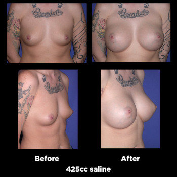 Breast-Augmentation14