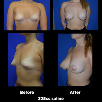 Breast-Augmentation15