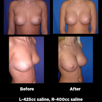 Breast-Augmentation16