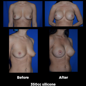 Breast-Augmentation17