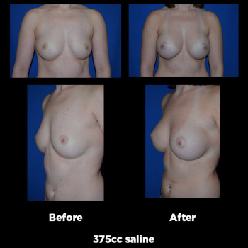 Breast-Augmentation22